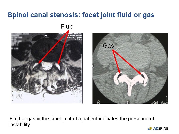 Spinal canal stenosis: facet joint fluid or gas Fluid Gas Fluid or gas in