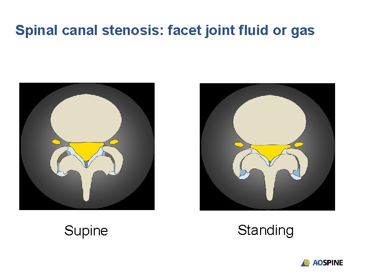 Spinal canal stenosis: facet joint fluid or gas Supine Standing 
