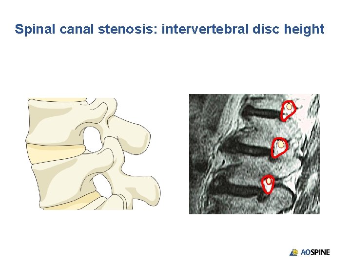 Spinal canal stenosis: intervertebral disc height 