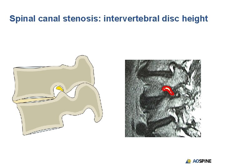 Spinal canal stenosis: intervertebral disc height 