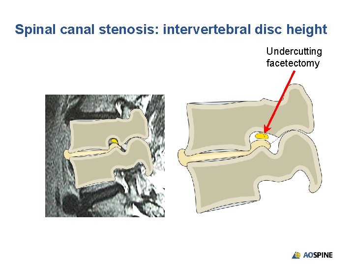 Spinal canal stenosis: intervertebral disc height Undercutting facetectomy 
