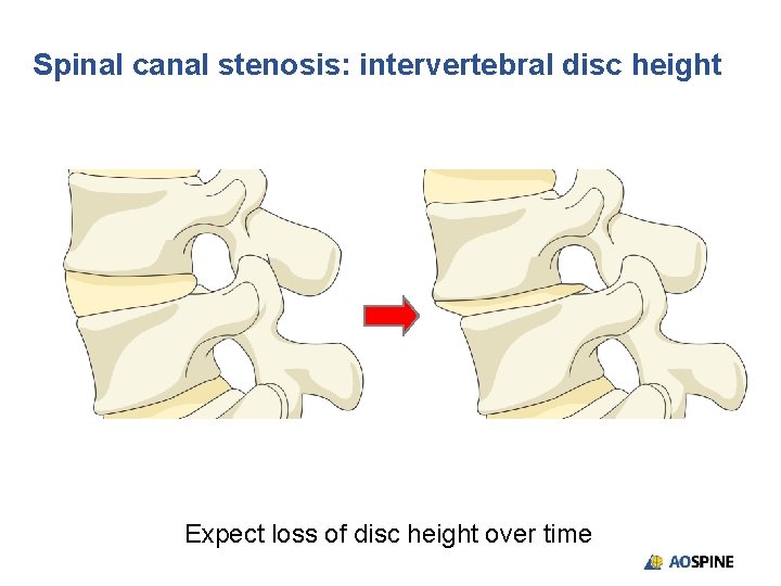 Spinal canal stenosis: intervertebral disc height Expect loss of disc height over time 