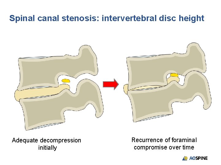 Spinal canal stenosis: intervertebral disc height Adequate decompression initially Recurrence of foraminal compromise over