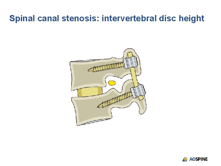 Spinal canal stenosis: intervertebral disc height 