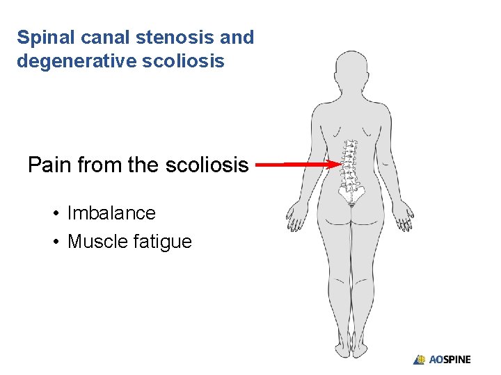 Spinal canal stenosis and degenerative scoliosis Pain from the scoliosis • Imbalance • Muscle