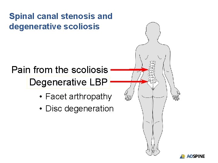 Spinal canal stenosis and degenerative scoliosis Pain from the scoliosis Degenerative LBP • Facet