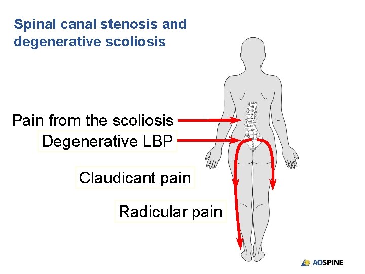 Spinal canal stenosis and degenerative scoliosis Pain from the scoliosis Degenerative LBP Claudicant pain