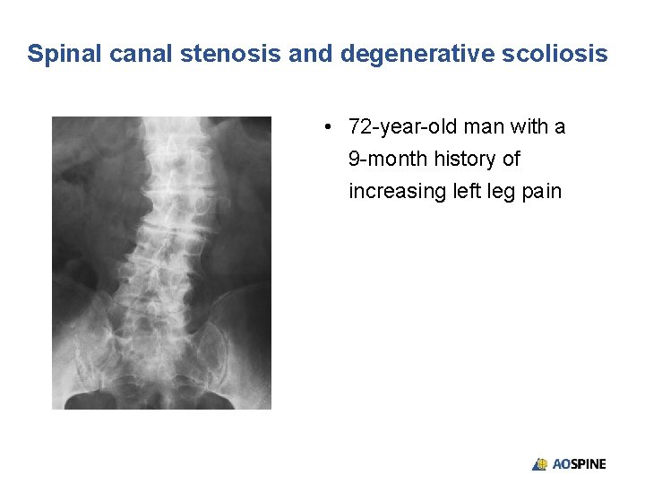 Spinal canal stenosis and degenerative scoliosis • 72 -year-old man with a 9 -month