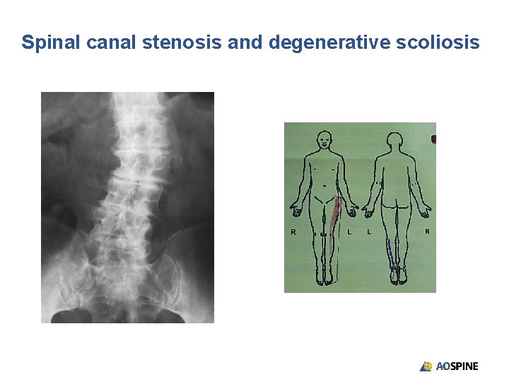 Spinal canal stenosis and degenerative scoliosis 