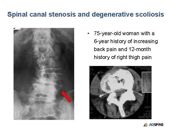 Spinal canal stenosis and degenerative scoliosis • 75 -year-old woman with a 6 -year