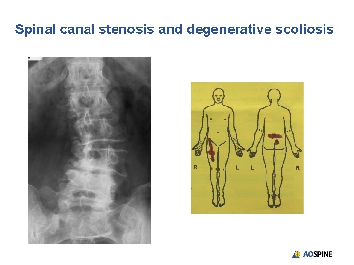 Spinal canal stenosis and degenerative scoliosis 
