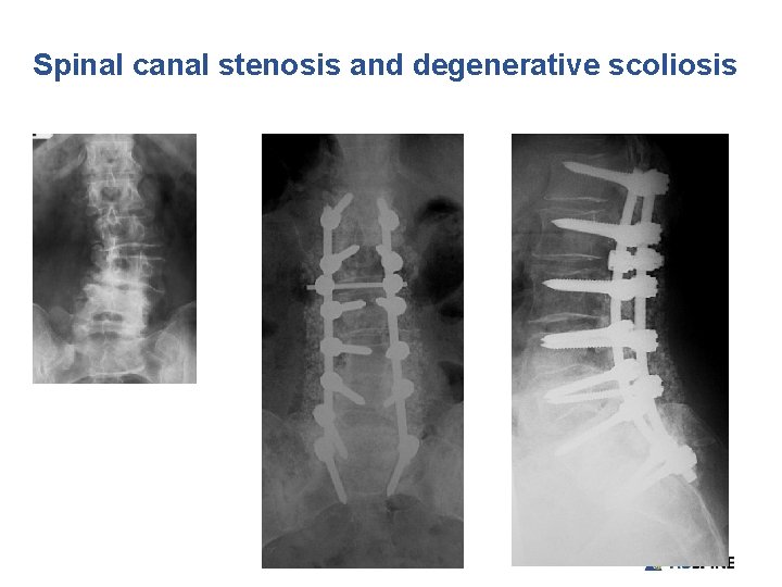 Spinal canal stenosis and degenerative scoliosis 