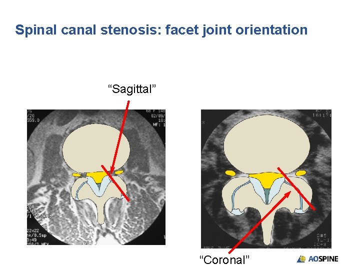 Spinal canal stenosis: facet joint orientation “Sagittal” “Coronal” 