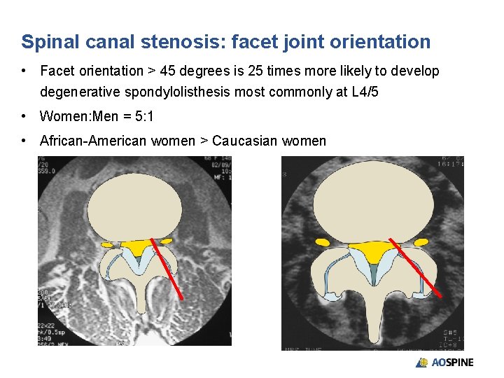 Spinal canal stenosis: facet joint orientation • Facet orientation > 45 degrees is 25