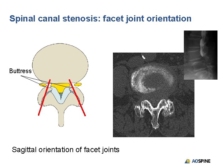 Spinal canal stenosis: facet joint orientation Buttress Sagittal orientation of facet joints 