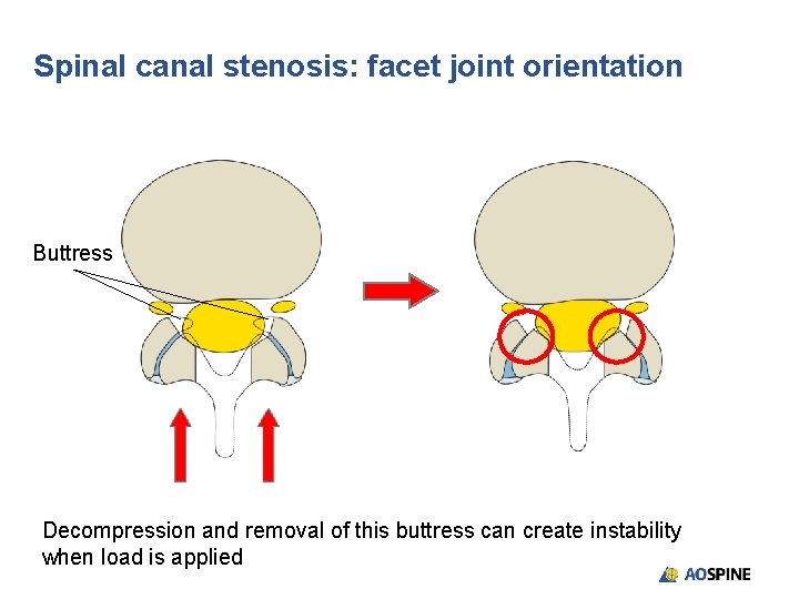 Spinal canal stenosis: facet joint orientation Buttress Decompression and removal of this buttress can