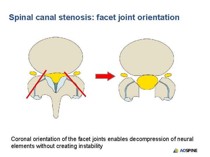 Spinal canal stenosis: facet joint orientation Coronal orientation of the facet joints enables decompression