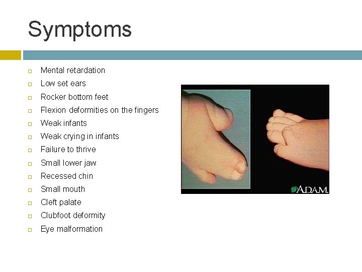 Symptoms Mental retardation Low set ears Rocker bottom feet Flexion deformities on the fingers