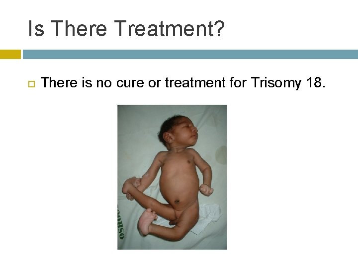 Is There Treatment? There is no cure or treatment for Trisomy 18. 