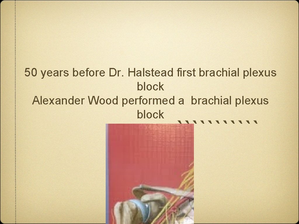 50 years before Dr. Halstead first brachial plexus block Alexander Wood performed a brachial