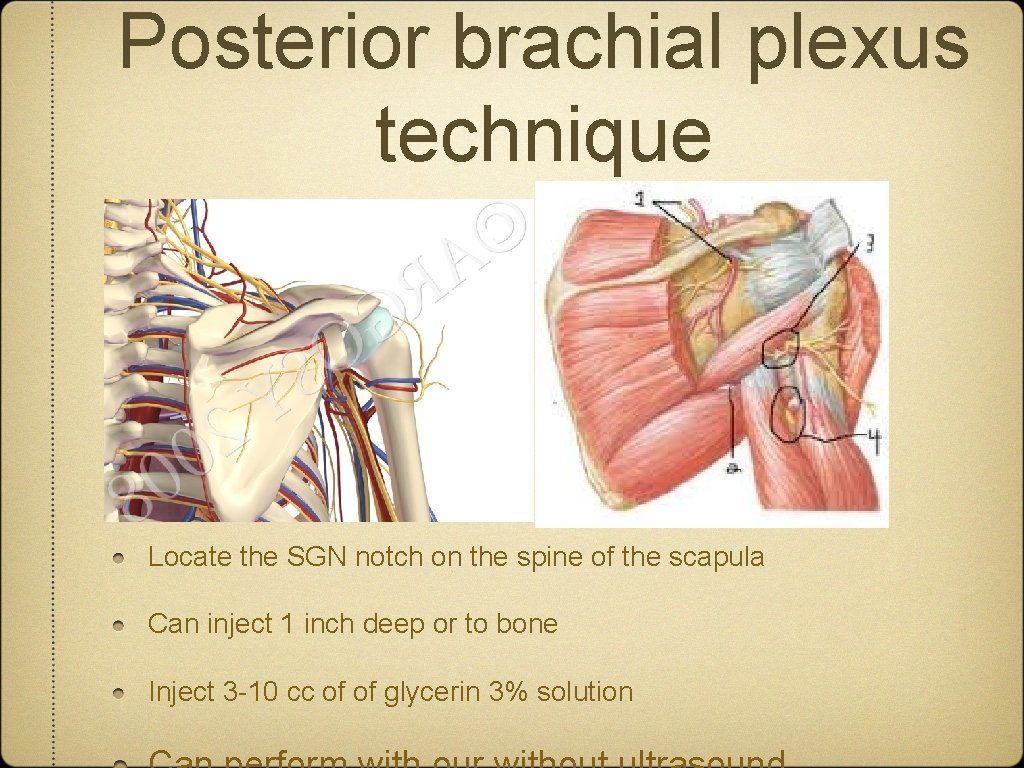 Posterior brachial plexus technique Locate the SGN notch on the spine of the scapula