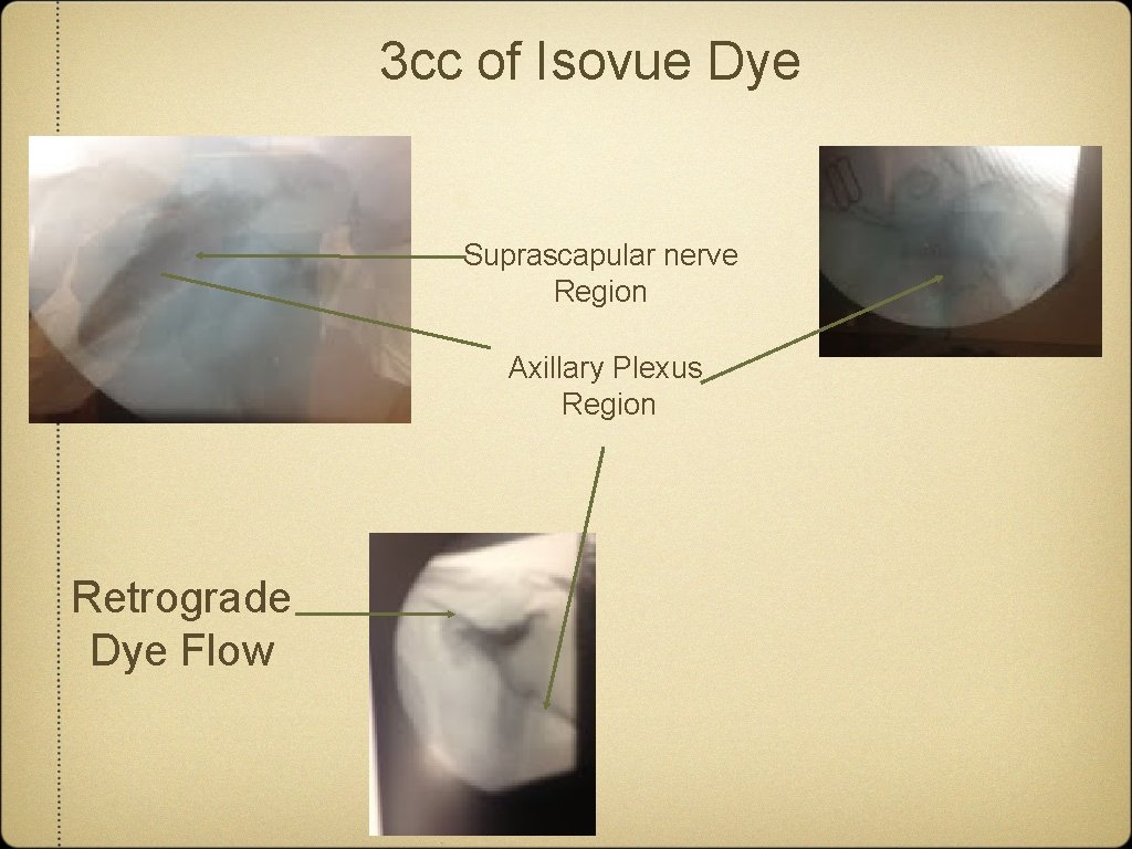 3 cc of Isovue Dye Suprascapular nerve Region Axillary Plexus Region Retrograde Dye Flow