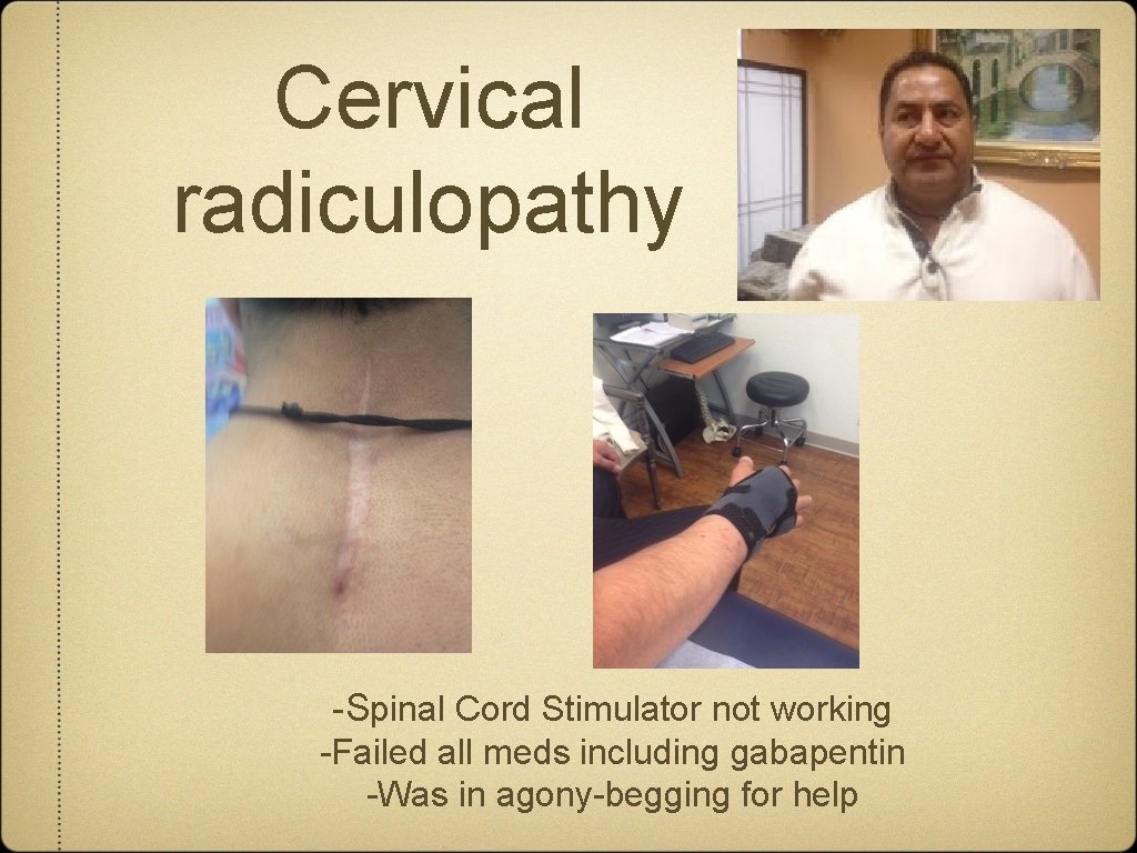 Cervical radiculopathy -Spinal Cord Stimulator not working -Failed all meds including gabapentin -Was in