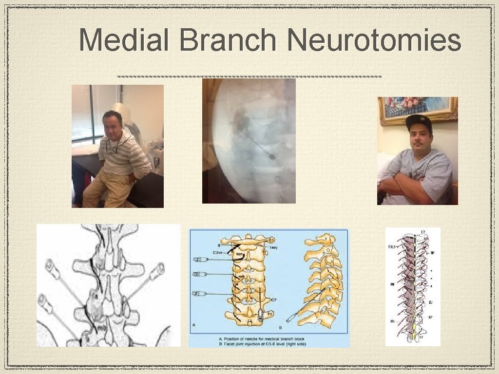 Medial Branch Neurotomies 