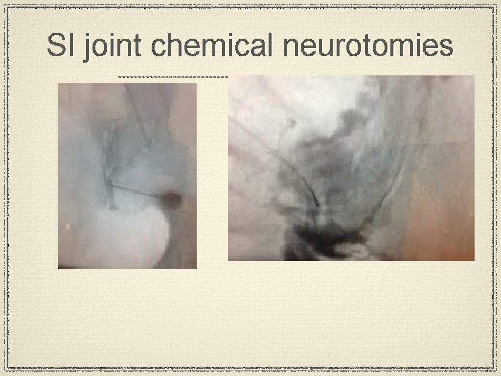 SI joint chemical neurotomies 
