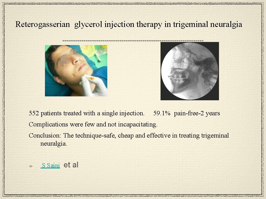 Reterogasserian glycerol injection therapy in trigeminal neuralgia 552 patients treated with a single injection.