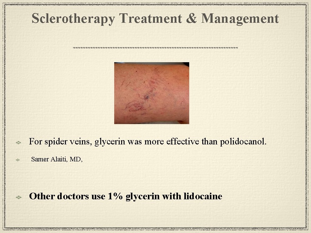 Sclerotherapy Treatment & Management For spider veins, glycerin was more effective than polidocanol. Samer
