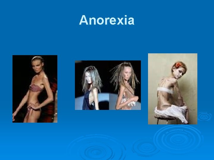 Anorexia 
