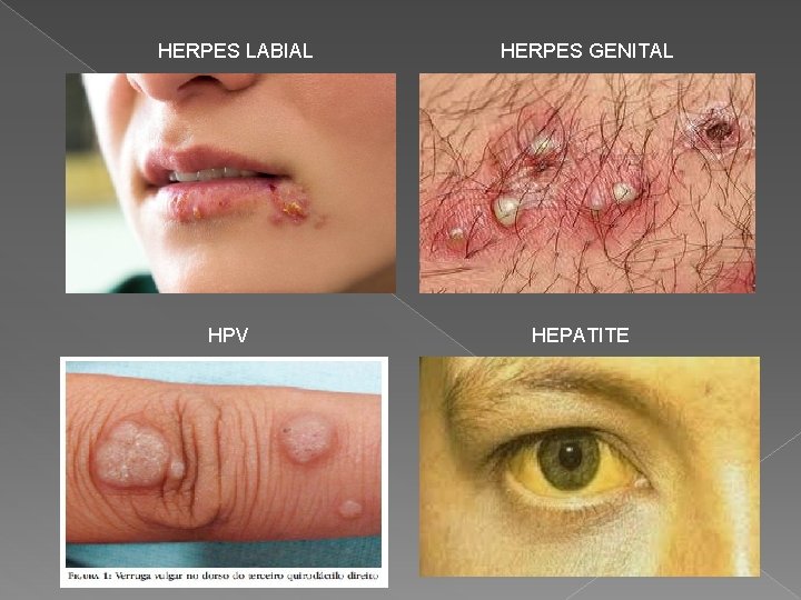 HERPES LABIAL HPV HERPES GENITAL HEPATITE 