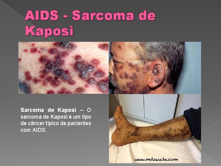 AIDS - Sarcoma de Kaposi – O sarcoma de Kaposi é um tipo de