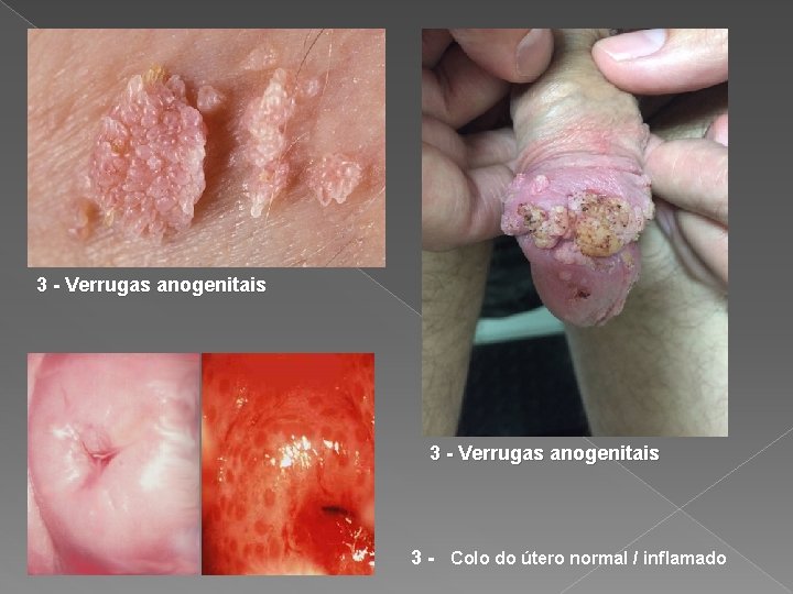 3 - Verrugas anogenitais 3 - Colo do útero normal / inflamado 
