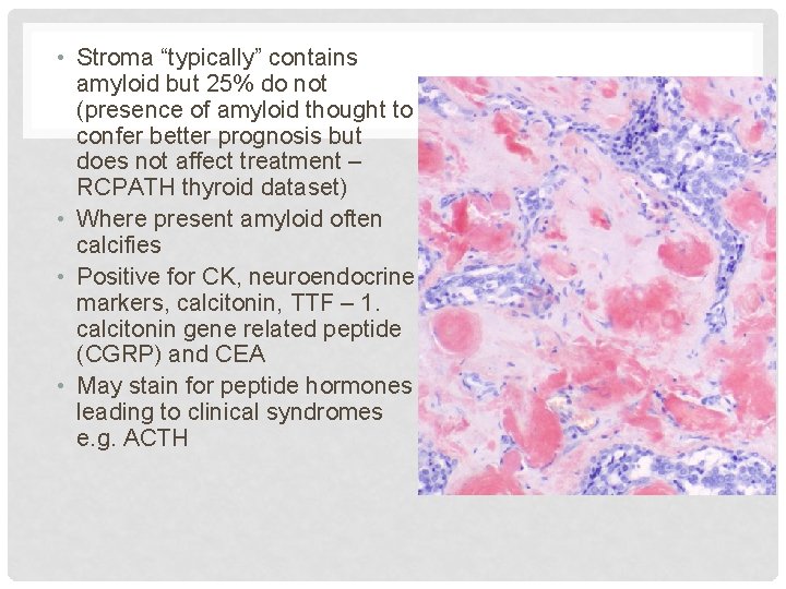  • Stroma “typically” contains amyloid but 25% do not (presence of amyloid thought