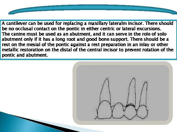 A cantilever can be used for replacing a maxillary lateralm incisor. There should be