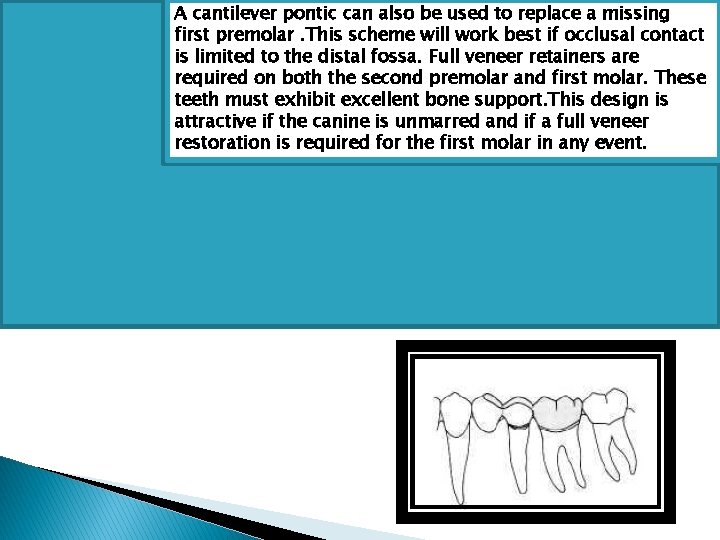 A cantilever pontic can also be used to replace a missing first premolar. This