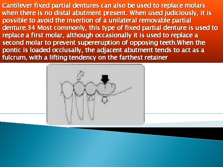 Cantilever fixed partial dentures can also be used to replace molars when there is