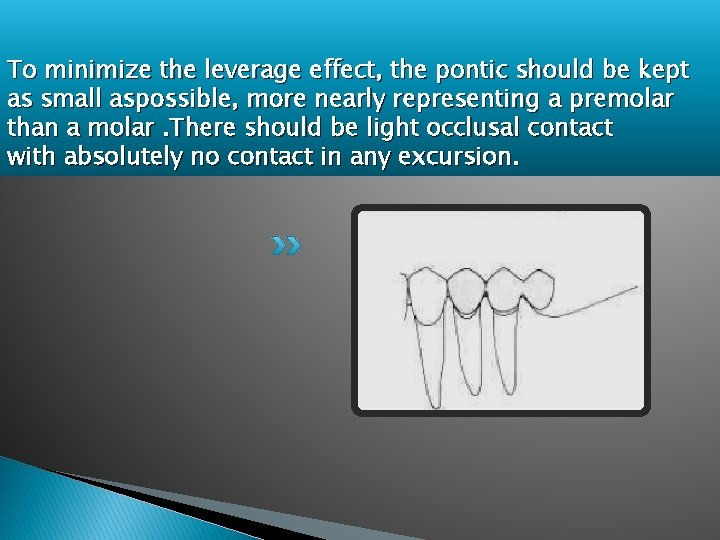 To minimize the leverage effect, the pontic should be kept as small aspossible, more