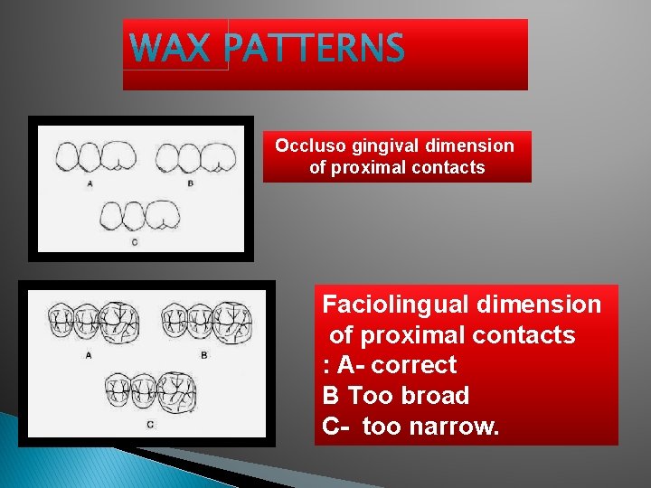Occluso gingival dimension of proximal contacts Faciolingual dimension of proximal contacts : A- correct