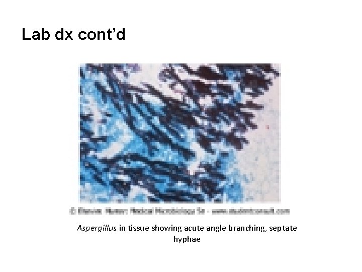 Lab dx cont’d Aspergillus in tissue showing acute angle branching, septate hyphae 