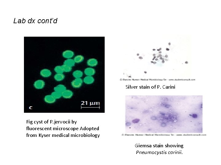 Lab dx cont’d Silver stain of P. Carini Fig cyst of P. jervocii by