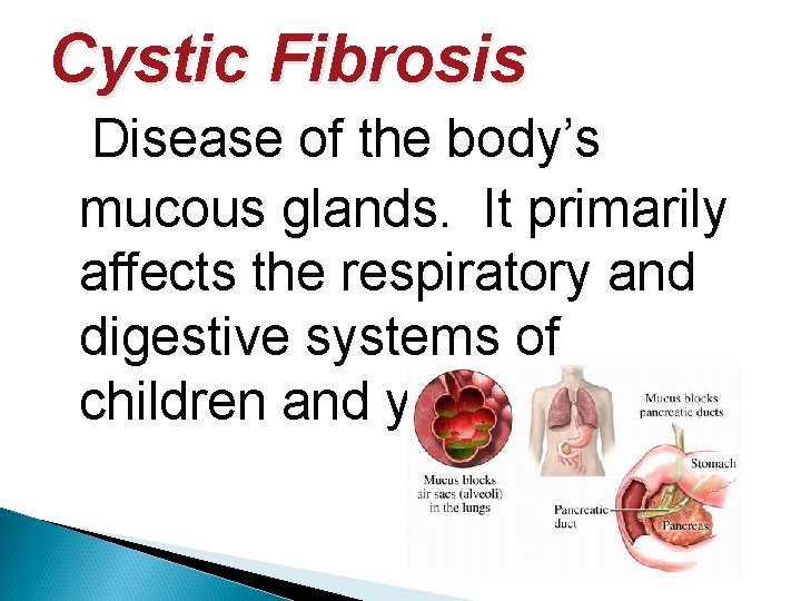 Cystic Fibrosis Disease of the body’s mucous glands. It primarily affects the respiratory and