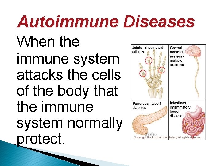 Autoimmune Diseases When the immune system attacks the cells of the body that the