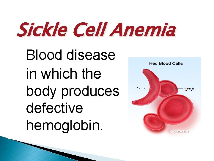 Sickle Cell Anemia Blood disease in which the body produces defective hemoglobin. 