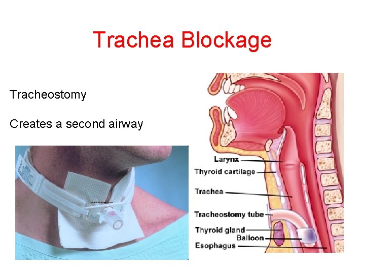 Trachea Blockage Tracheostomy Creates a second airway 