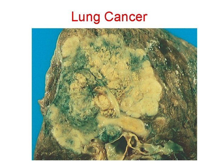 Lung Cancer 