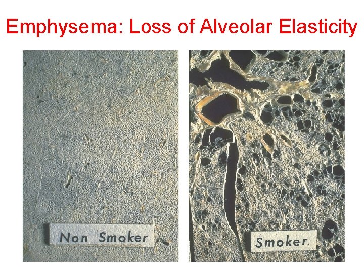 Emphysema: Loss of Alveolar Elasticity 
