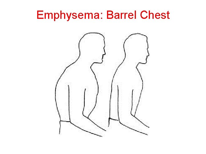 Emphysema: Barrel Chest 